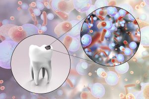 diagnosing cavities