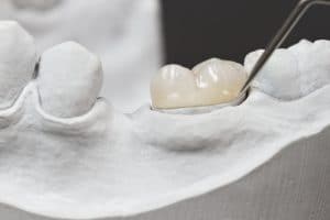 dental crowns