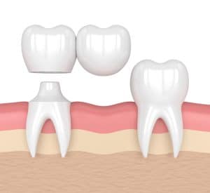 dental bridge