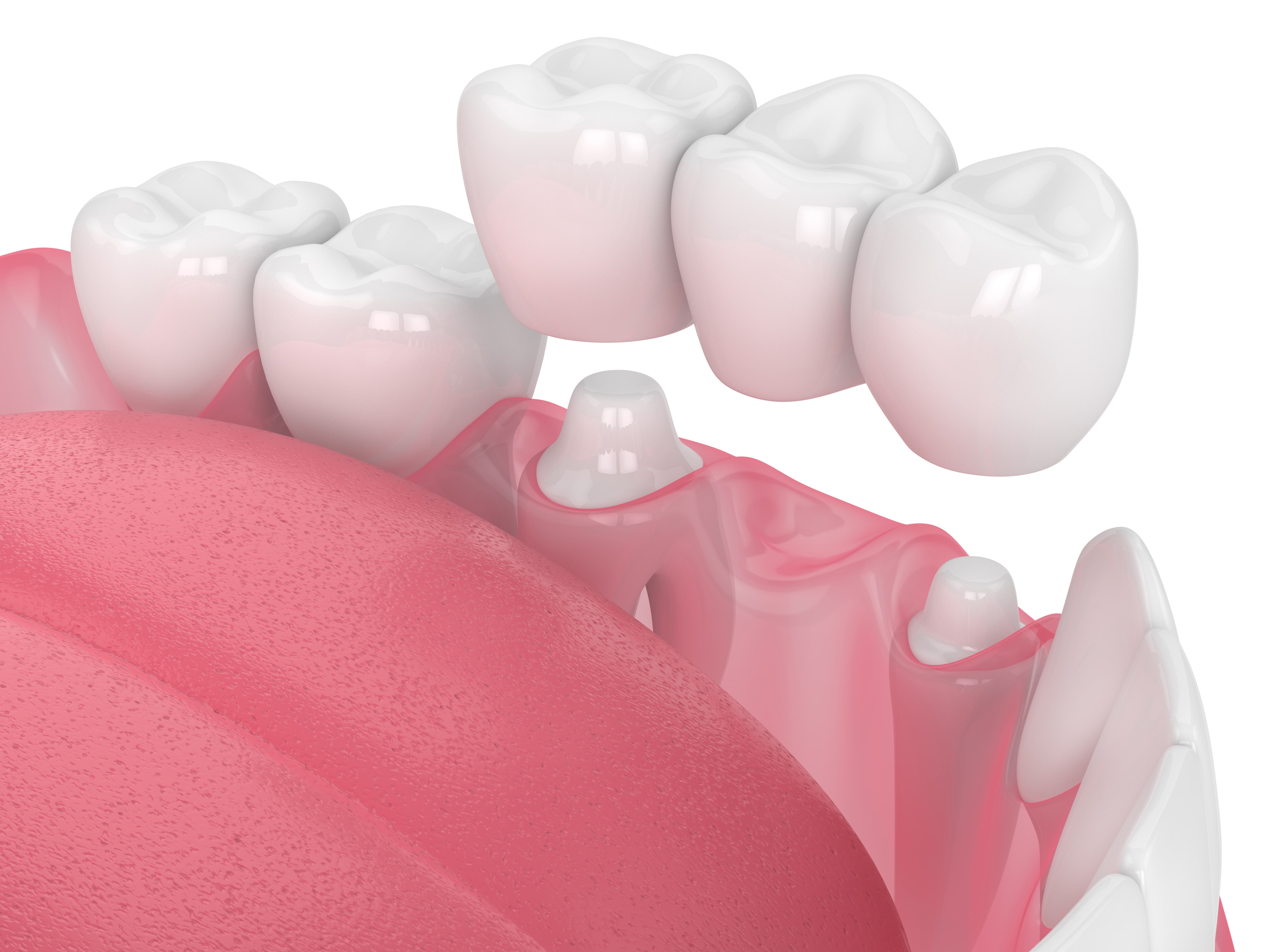 livonia-dentist-uses-a-bridge-to-treat-minor-tooth-loss-livonia-mi