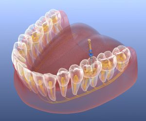 livonia root canal therapy