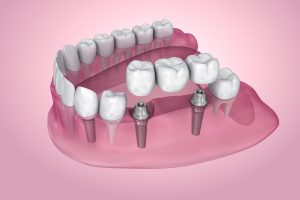 livonia dental bridge