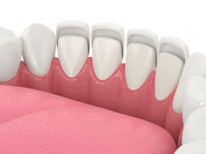 livonia porcelain veneers