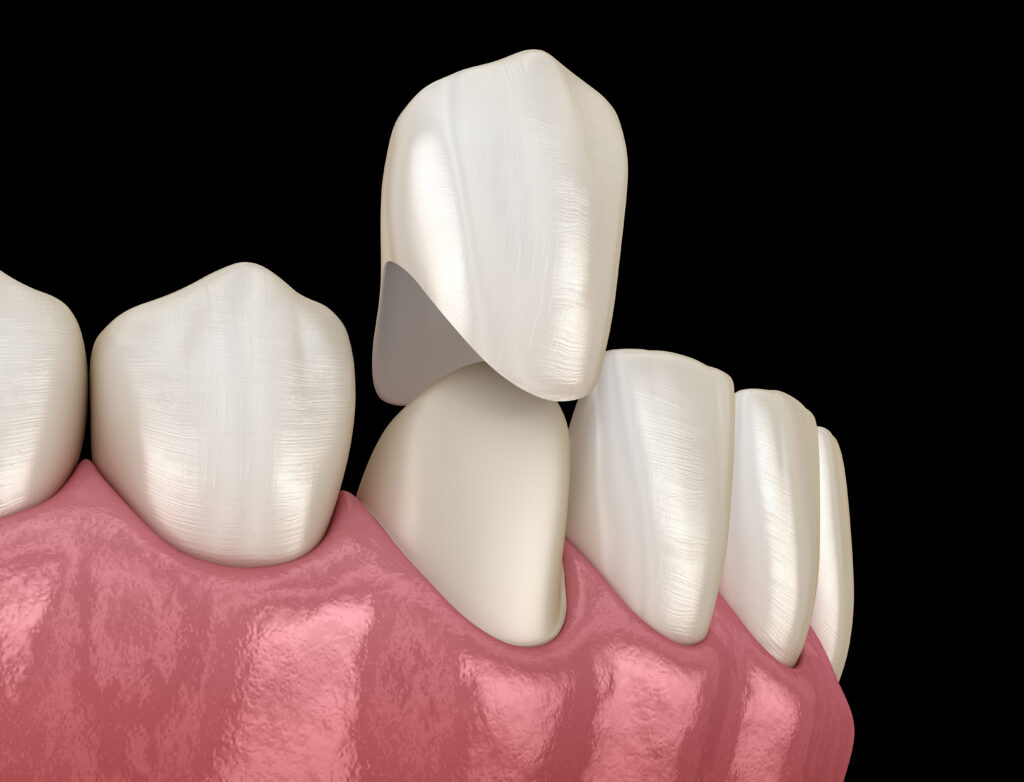 Innovative Repair With Dental Crowns Livonia, MI