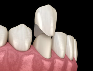 livonia dental crowns