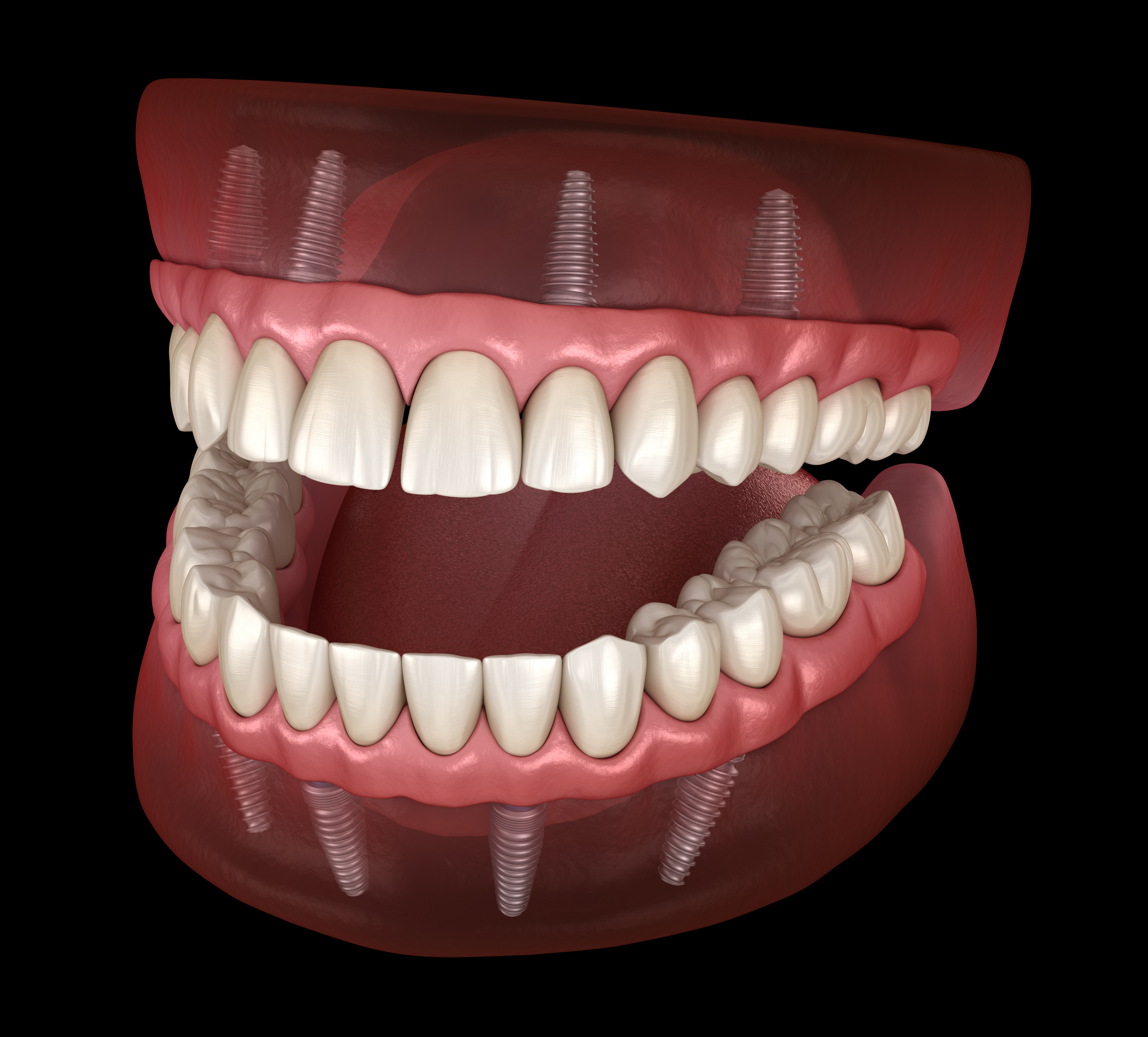 Helping People With Total Tooth Loss | Livonia, MI