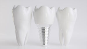 livonia dental implants