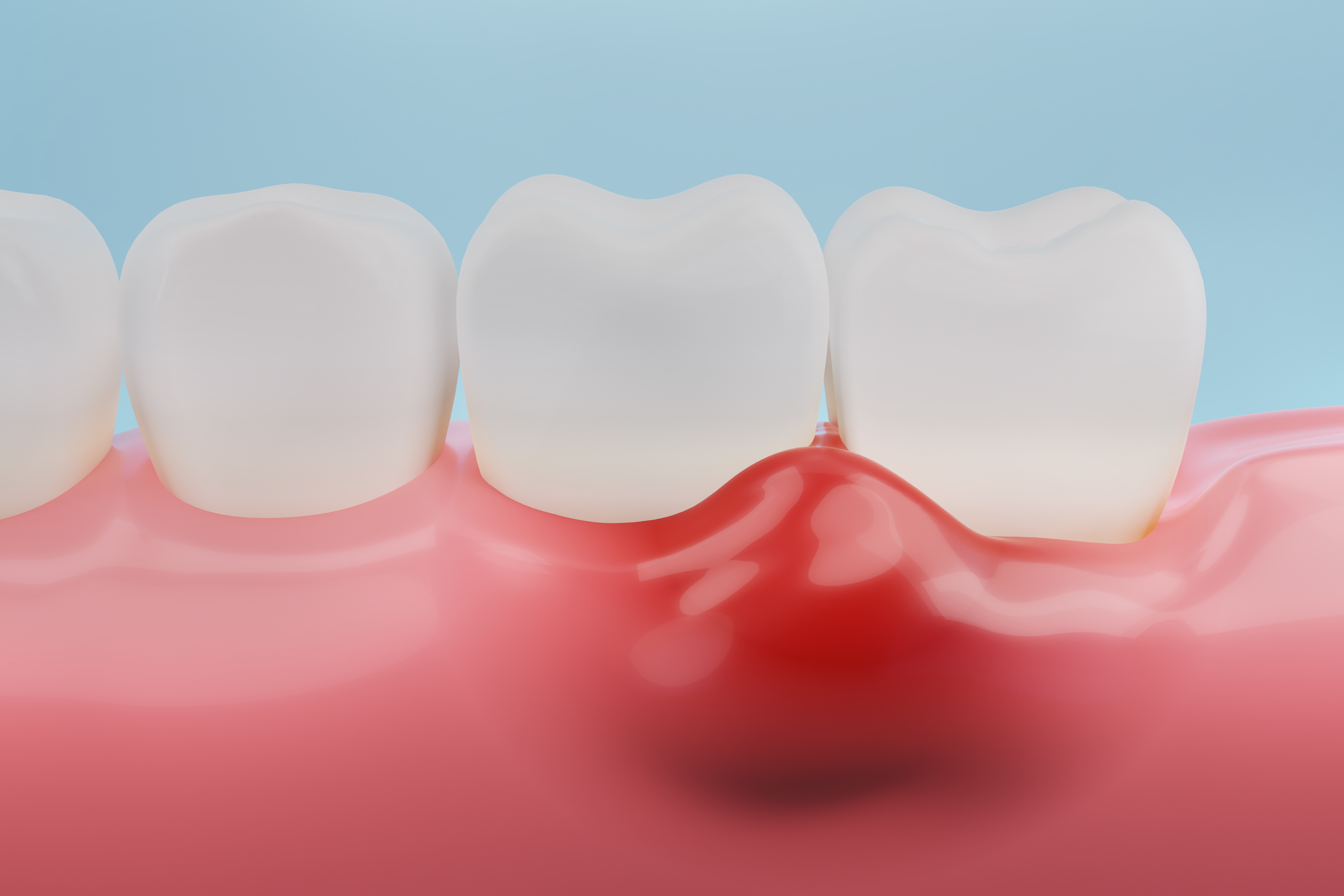 inflamed-gums-could-mean-infection-livonia-mi