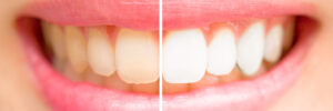 livonia teeth whitening