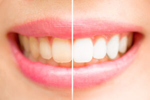 livonia teeth whitening