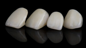 livonia dental crowns