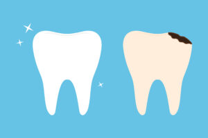 Livonia, MI, dentist offers dental fillings for cavities 