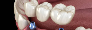 livonia dental bridge