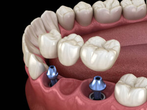 livonia dental bridge