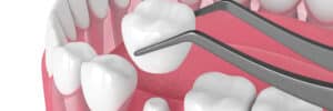 livonia dental crowns