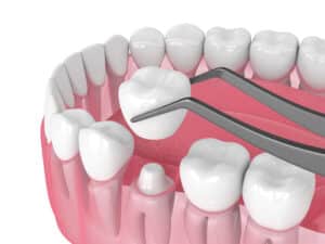 livonia dental crowns
