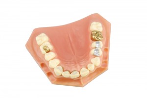 dentalfillings