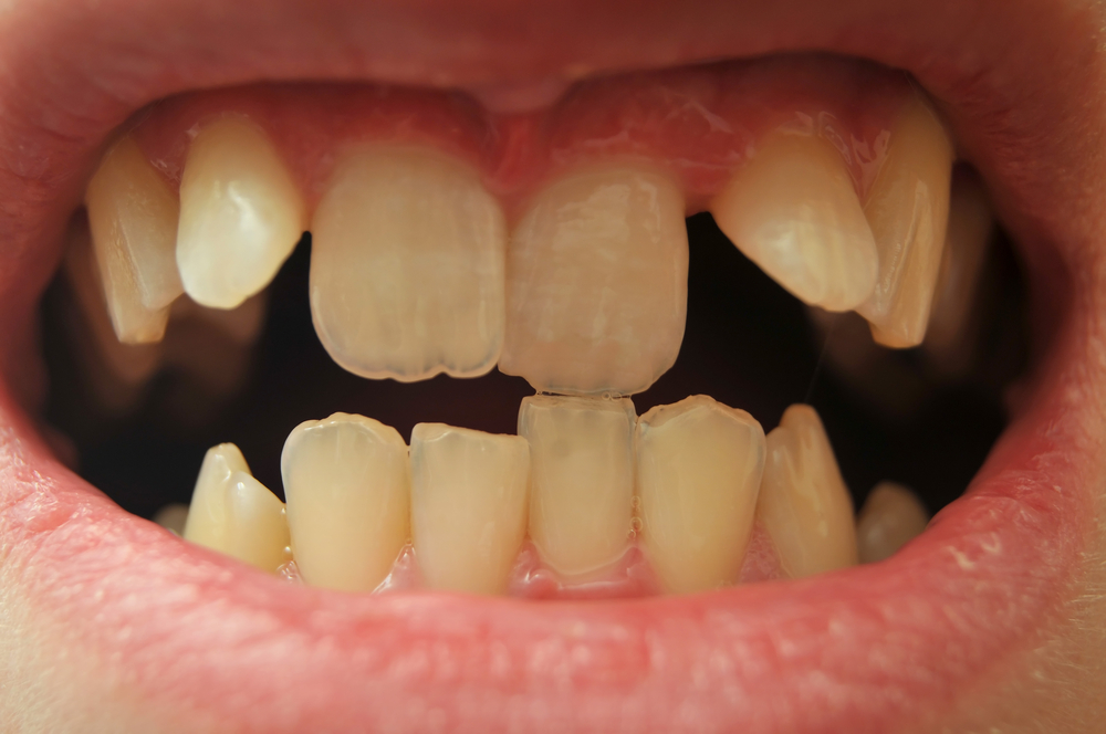 what-causes-crooked-teeth-livonia-mi