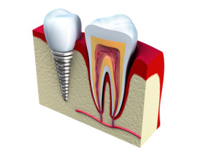 dentalimplants