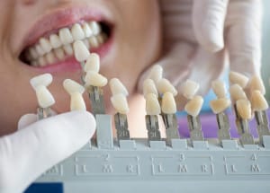 teeth whitening consult
