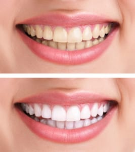 teethwhiteningtransform