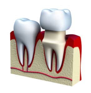 dentalcrownwred