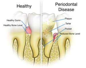 stewart gum disease