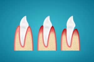 stewart-gum-disease